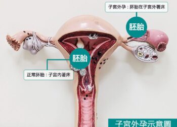 子宮外孕奪命風險高　東港安泰醫院成功搶救休克孕婦