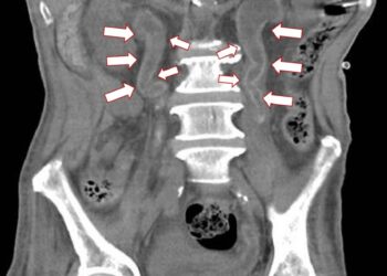 影音/結石不成塊滿覆蓋泌尿道　醫師：多喝水 不要憋尿 適度運動