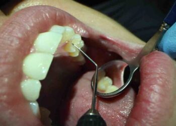 智齒究竟要不要拔？拔牙後得放膠原蛋白嗎？ 牙醫師提供「4關鍵」一次解惑！