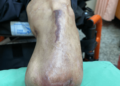 影音/糖尿病患因病變去年左腳截肢 員榮傷口治療今年保住右腳