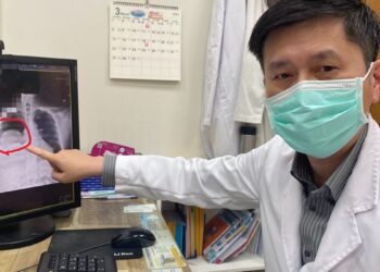 男子低血糖反覆發作竟非糖尿病 多次昏迷送醫揪出25公分罕見肺腫瘤
