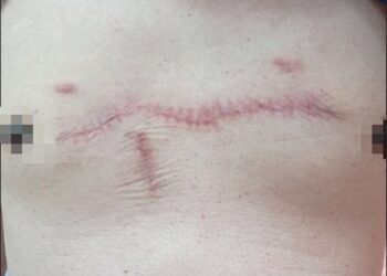 男青春痘捏破異常增生變成「大蜈蚣」 員榮整形妙手以羊膜因子改善蟹足腫