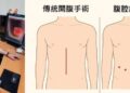 高齡男腹痛就醫發現「胃癌」 高市大同醫院運用微創手術助康復
