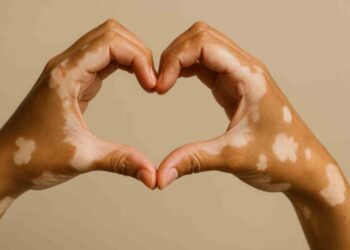 皮膚長白斑無藥可醫？什麼是白斑？如何停止擴散？治療方式一次看清！