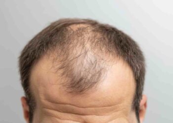 「生髮產品」是智商稅？女性也會雄性禿？ 4大落髮「都市傳說」醫師一次解析！