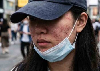 滿臉「痘」花好焦慮！痘疤、凹疤怎處理？誰適合痘疤手術？醫提「4大」關鍵