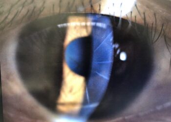 舊式近視矯正術後遺症頻發?信賴眼科有解 引進義大利新儀器「角膜斷層掃瞄儀」