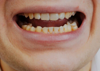 世界檳榔防治日｜嚼檳榔危及健康！罹口腔癌風險增28倍，加菸酒風險增百倍