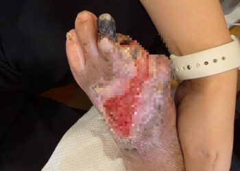 婦剪趾甲竟變截掉兩根腳趾 經歷清創靠中醫雷射針灸重新站起來